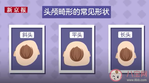 网红矫正头盔或影响婴儿发育 定型枕定型头盔有用吗 网红矫正头盔或影响婴儿发育 定型枕定型头盔有用吗