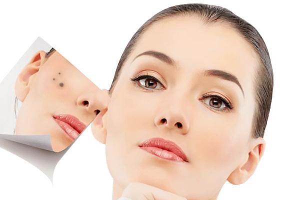 点痣去医院挂什么科 点痣后需要注意什么事项 点痣去医院挂什么科 点痣后需要注意什么事项