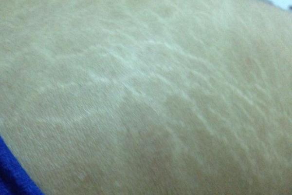 肥胖纹是横的还是竖的 肥胖纹要多久才能完全消除吗