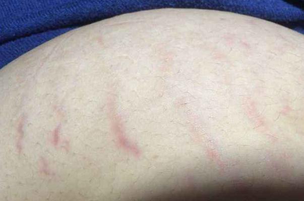 肥胖纹是横的还是竖的 肥胖纹要多久才能完全消除吗