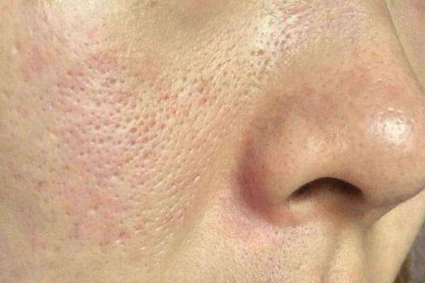 收缩毛孔最佳方法 收缩毛孔用什么比较好 收缩毛孔最佳方法 收缩毛孔用什么比较好