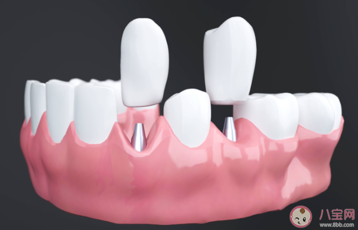 为什么种植牙费用这么高 种植牙的费用包括什么