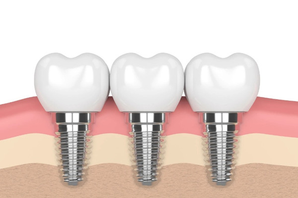 种植牙后多久能吃东西 种植牙后怎么刷牙 种植牙后多久能吃东西 种植牙后怎么刷牙