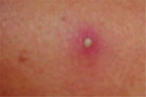 火疖子长屁股上怎么办 火疖子哪里都长吗