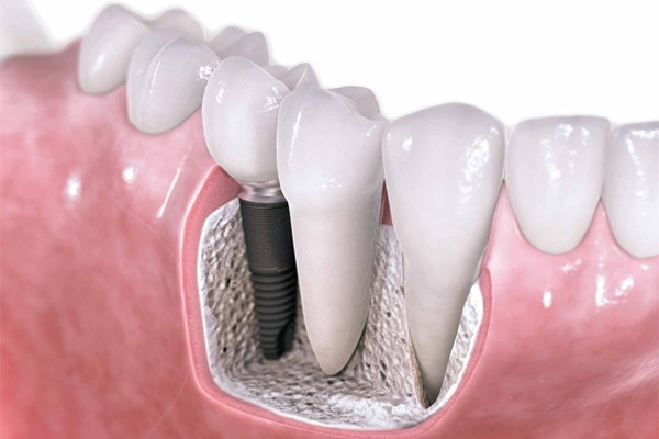 种植牙后多久能吃东西 种植牙后怎么刷牙 种植牙后多久能吃东西 种植牙后怎么刷牙