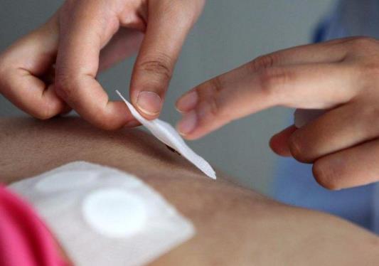 三伏贴第三次没有贴会不会没效果?三伏贴第二贴晚一天贴行吗