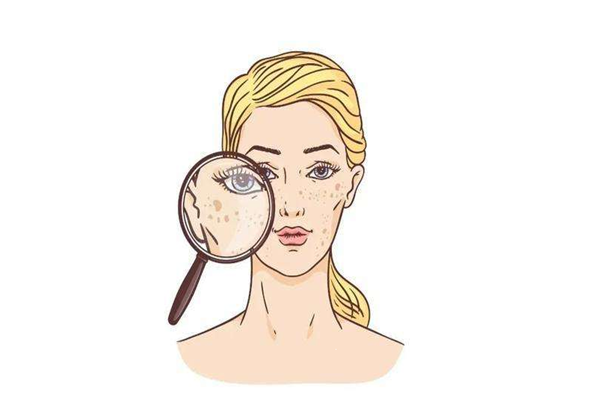 黄褐斑是怎么样形成的 黄褐斑是什么样子 黄褐斑是怎么样形成的 黄褐斑是什么样子