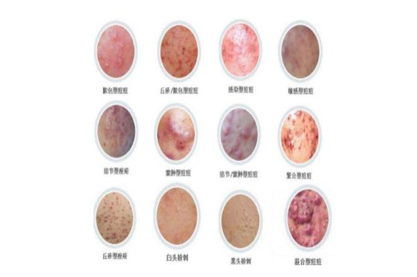 痘痘肌肤怎么修复 痘痘肌肤适合用什么牌子的护肤品 痘痘肌肤怎么修复 痘痘肌肤适合用什么牌子的护肤品