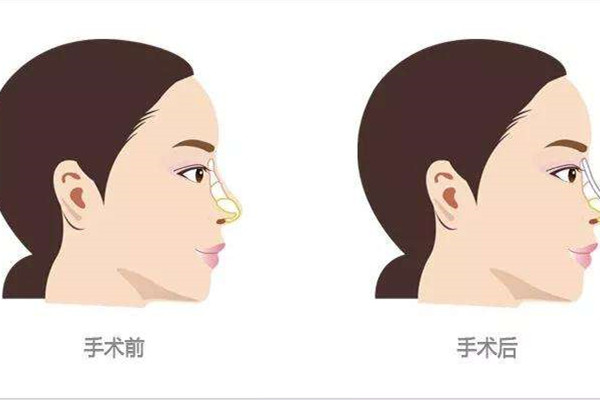 隆鼻后后遗症有哪些呢 隆鼻手术后注意事项 隆鼻后后遗症有哪些呢 隆鼻手术后注意事项