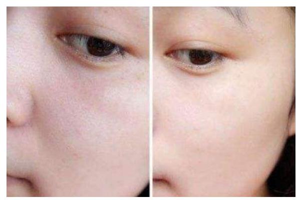 收缩毛孔最佳方法 收缩毛孔用什么比较好 收缩毛孔最佳方法 收缩毛孔用什么比较好