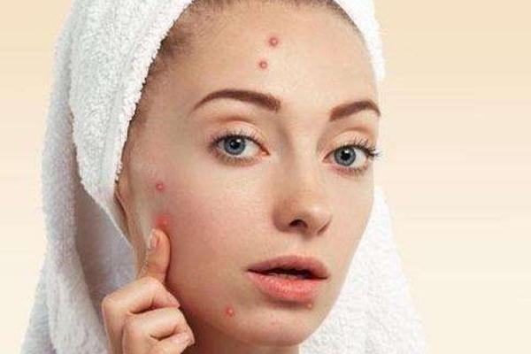 痘痘肌肤怎么修复 痘痘肌肤适合用什么牌子的护肤品 痘痘肌肤怎么修复 痘痘肌肤适合用什么牌子的护肤品