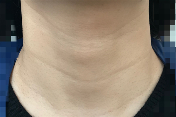 颈纹去除术可以维持多久 颈纹去除术是永久的吗