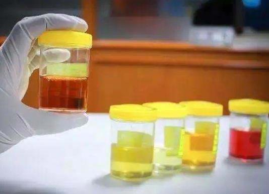 尿酸550不吃药能降回正常值吗?年轻人尿酸长期500左右严重吗