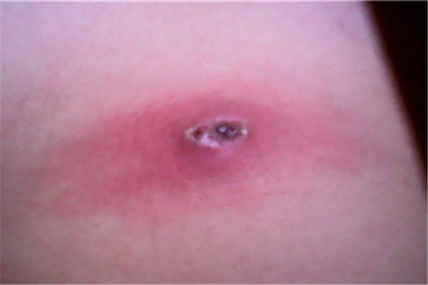 火疖子会自愈吗 火疖子长什么样