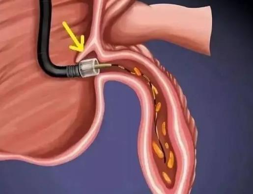 男人和女人的阑尾位置一样吗?阑尾炎饭后多久才可以运动?