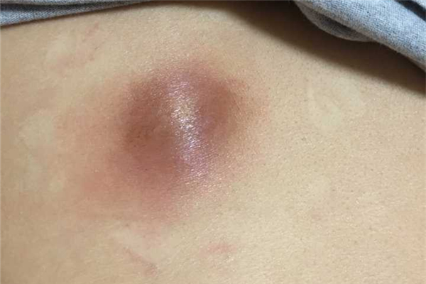 火疖子怎么治疗最快 火疖子是什么引起的 火疖子怎么治疗最快 火疖子是什么引起的