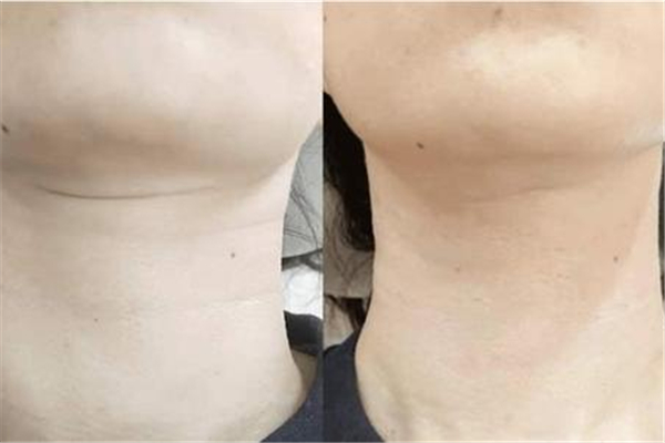 颈纹嗨体注射一次多少钱 颈纹嗨体是什么 颈纹嗨体注射一次多少钱 颈纹嗨体是什么