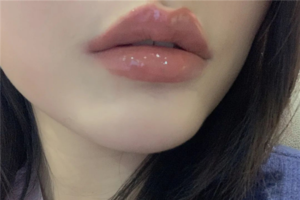 丰唇后多久消肿 丰唇后要冰敷吗 丰唇后多久消肿 丰唇后要冰敷吗