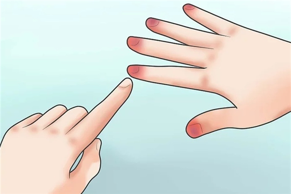 冻疮可以涂红霉素软膏吗 冻疮涂芦荟胶有用吗