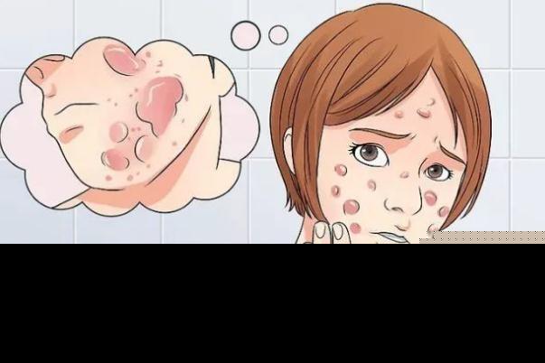 青春痘对身体有什么危害 长青春痘的好处与坏处