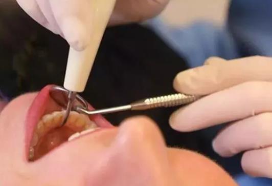 拔牙是整个连根拔起吗?拔牙是整体的还是打碎拔好