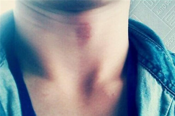 吻痕用鸡蛋热敷管用吗 吻痕用鸡蛋敷过后什么时候能消