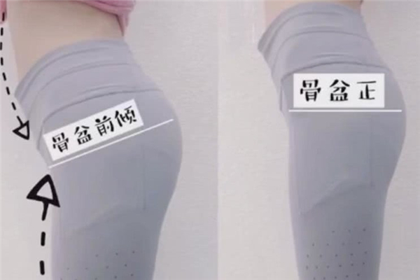 骨盆前倾的症状有哪些表现 骨盆前倾的原因