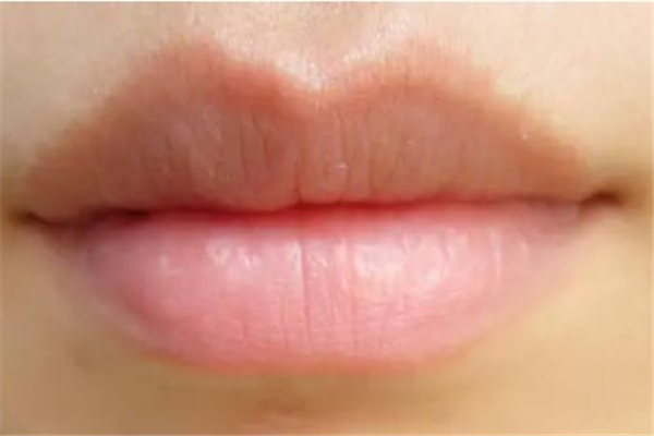丰唇可以吃消炎药吗 丰唇吃什么食物