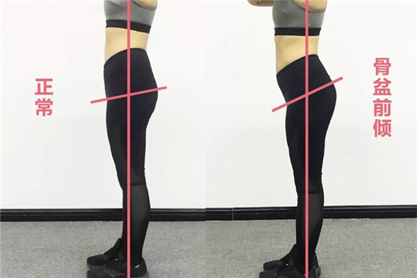 骨盆前倾有必要矫正吗 骨盆前倾对身体的危害 骨盆前倾有必要矫正吗 骨盆前倾对身体的危害