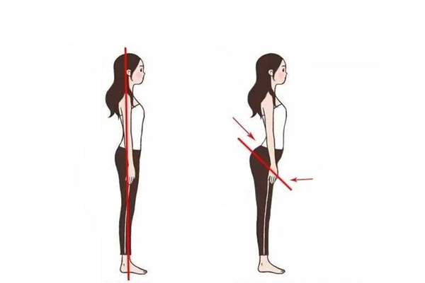 骨盆前倾有必要矫正吗 骨盆前倾对身体的危害 骨盆前倾有必要矫正吗 骨盆前倾对身体的危害