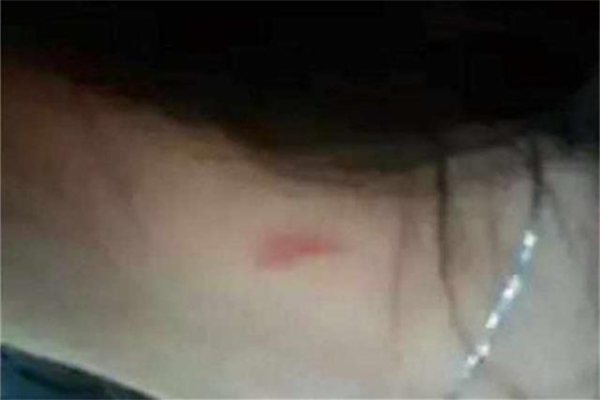 吻痕用鸡蛋热敷管用吗 吻痕用鸡蛋敷过后什么时候能消