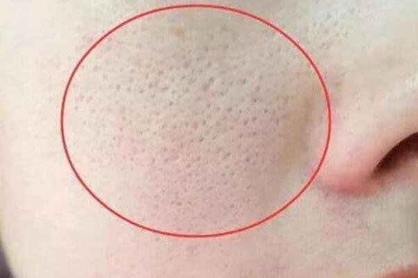 收缩毛孔最佳方法 收缩毛孔用什么比较好 收缩毛孔最佳方法 收缩毛孔用什么比较好