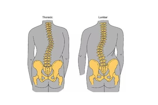 骨盆前倾可以通过正骨恢复吗 骨盆前倾去哪里矫正 骨盆前倾可以通过正骨恢复吗 骨盆前倾去哪里矫正