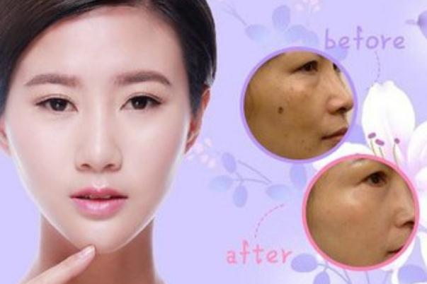 点痣去医院挂什么科 点痣后需要注意什么事项 点痣去医院挂什么科 点痣后需要注意什么事项