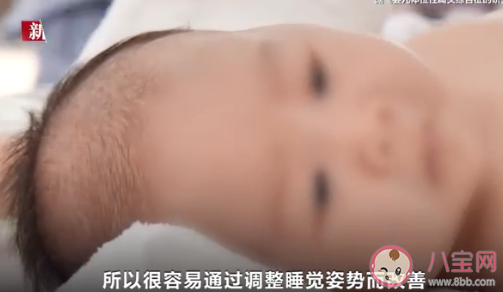 网红矫正头盔或影响婴儿发育 定型枕定型头盔有用吗 网红矫正头盔或影响婴儿发育 定型枕定型头盔有用吗
