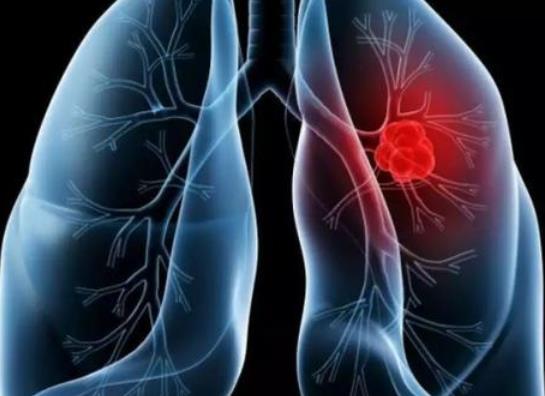 单位体检一半人都有肺结节吗?10个人有9个人有肺结节是真的吗