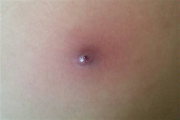 火疖子怎么治疗最快 火疖子是什么引起的 火疖子怎么治疗最快 火疖子是什么引起的