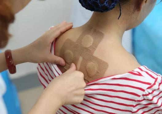 贴三伏贴后多久可以同房?三伏贴和艾灸一起做好不好