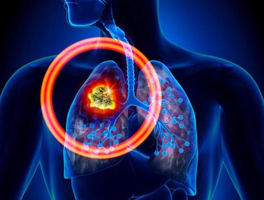 单位体检一半人都有肺结节吗?10个人有9个人有肺结节是真的吗