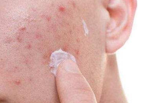 痘痘肌肤怎么修复 痘痘肌肤适合用什么牌子的护肤品 痘痘肌肤怎么修复 痘痘肌肤适合用什么牌子的护肤品