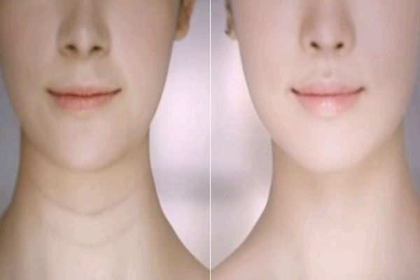 颈纹去除术一般多少钱 颈纹特别深怎么去除