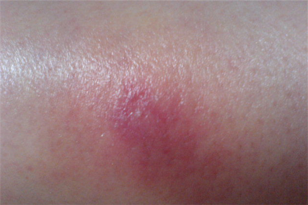 火疖子长屁股上怎么办 火疖子哪里都长吗